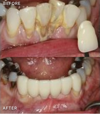 Dental before and after comparison showing tooth restoration and whitening treatment results.