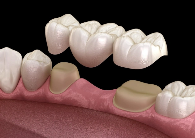 Dental implants and crowns model showing replacement teeth on gum tissue structure.